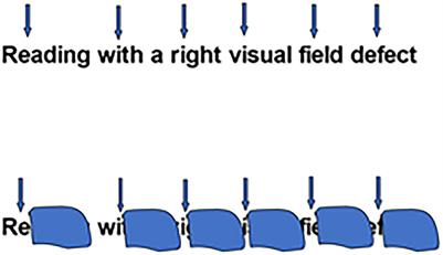 Cortical Visual Impairments and Learning Disabilities